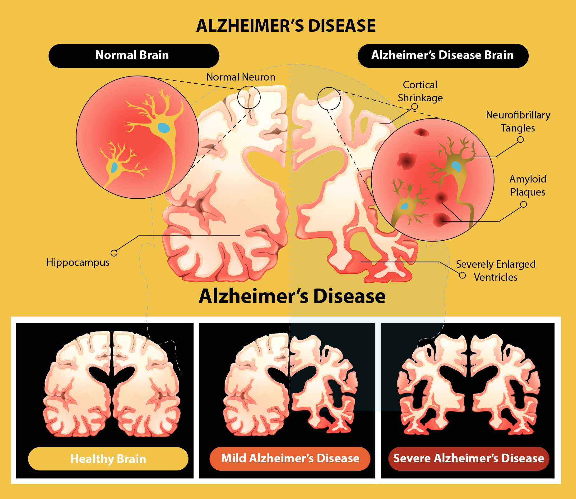 Болезнь альцгеймера: симптомы и признаки, лечение