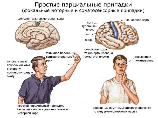 Эпилепсия