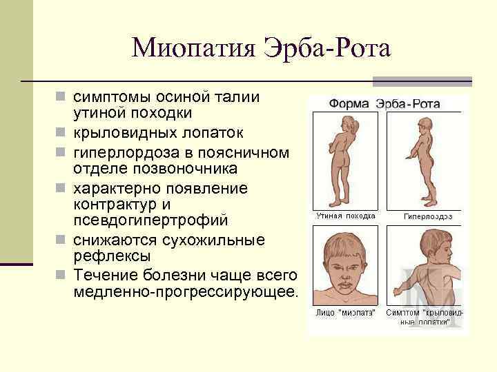 Миопатия, что это такое, причины возникновения и лечение