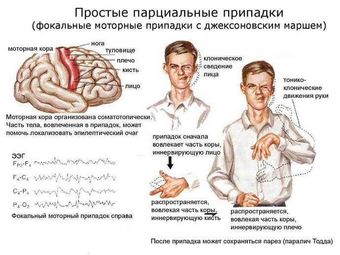 Симптомы эпилепсии