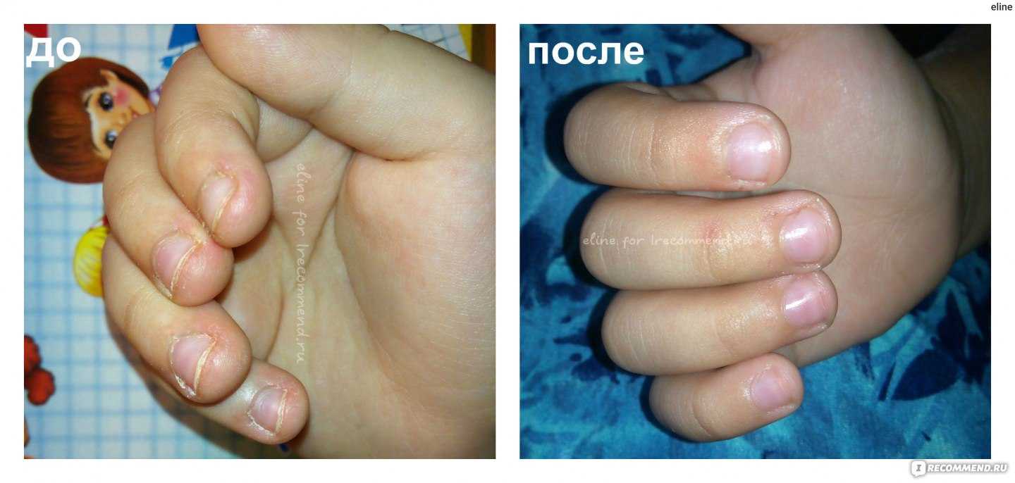 Почему ребенок грызет ногти