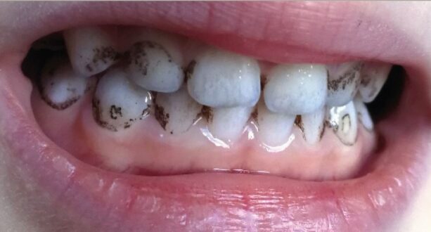 почернение зубов у детей.