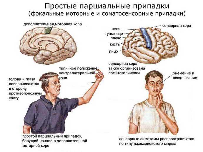 Разновидности и особенности протекания височной эпилепсии
