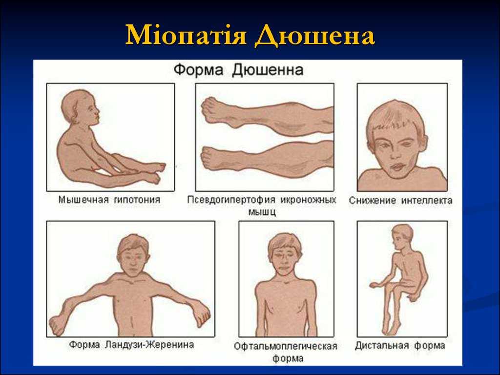 Миопатия: что это такое, лечение, симптомы, причины, признаки
