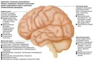 Причины и лечение фокальной эпилепсии