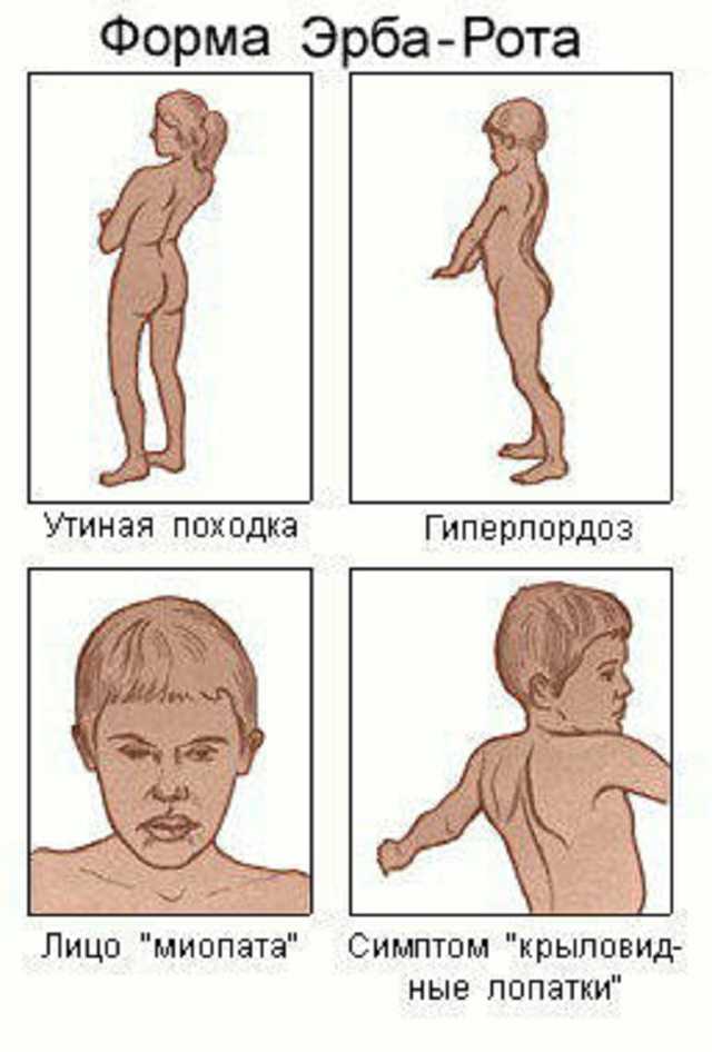Миопатия у детей - лечение, причины и симптомы миопатии | детская неврология см-клиники в санкт-петербурге