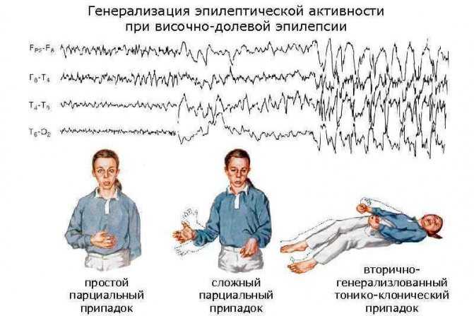 Эпилепсия у детей: симптомы и лечение. как выглядит приступ. причины эпилепсии у детей