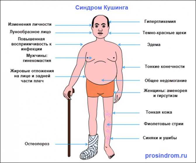 Синдром апера: причины появления, симптомы, диагностика и лечение заболевания :: syl.ru