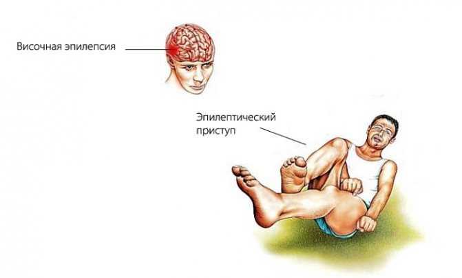 Эпилепсия у детей: причины, проявление и симптомы
