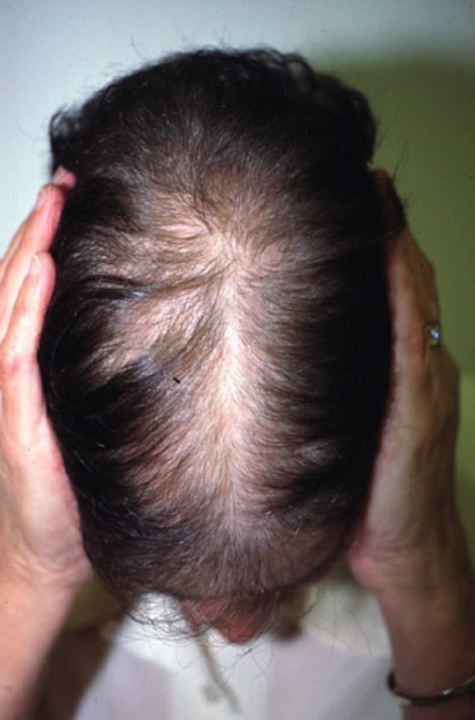 Трихотилломания – расстройство вырывания волос | психосома
