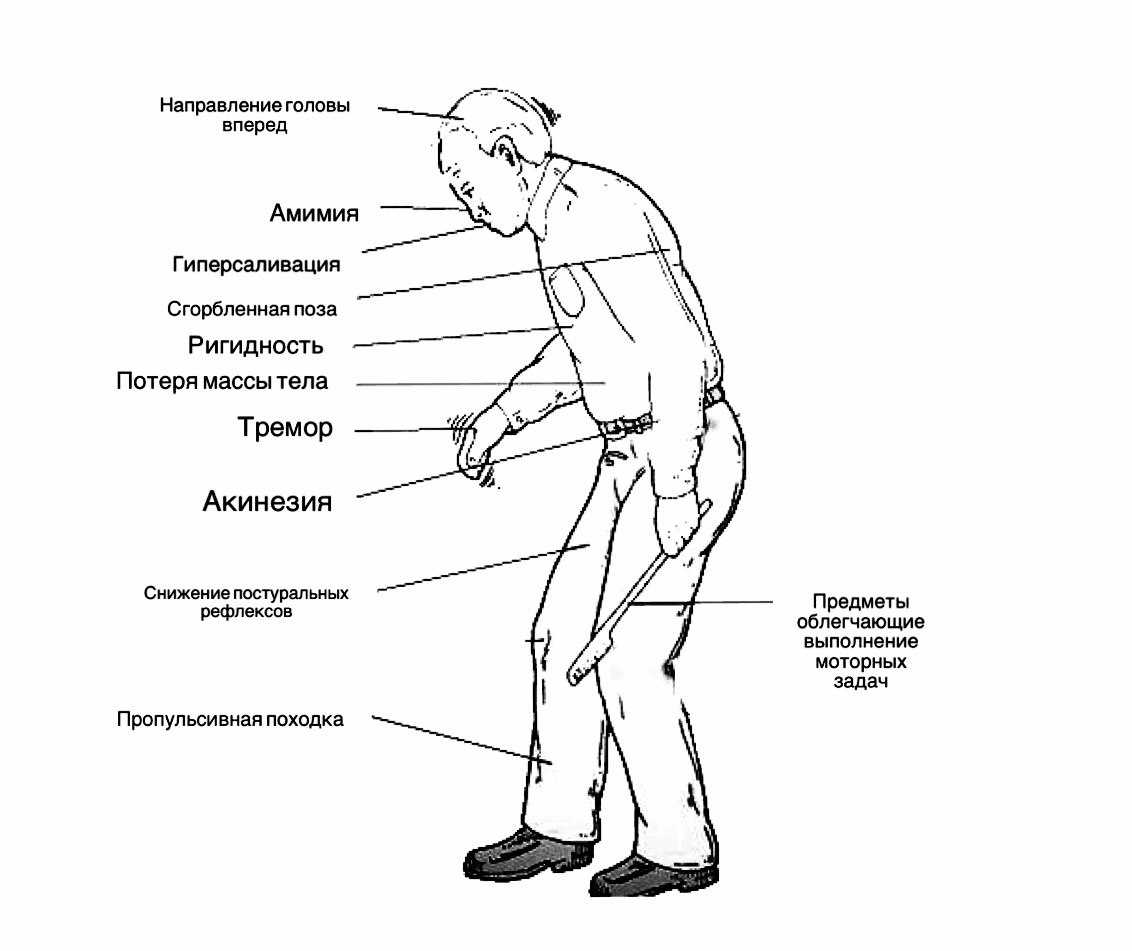 Виды, симптомы и лечение паркинсонизма | medboli.ru
