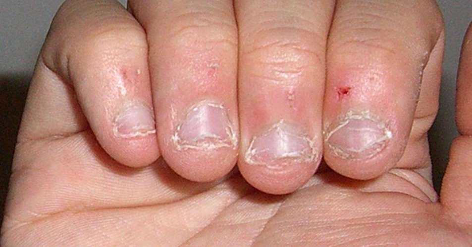 Как отучить ребенка грызть ногти | уроки для мам