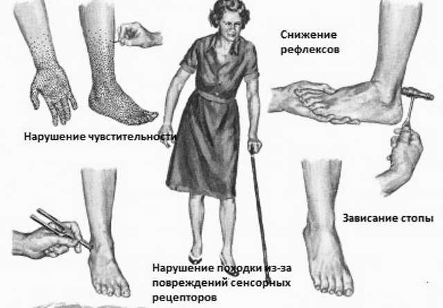 Полинейропатия конечностей — симптомы и лечение