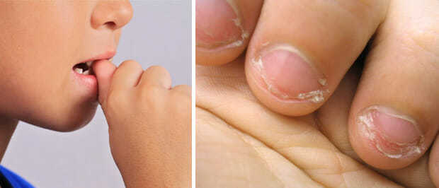 Как отучить ребенка грызть ногти, причины онихофагии у детей