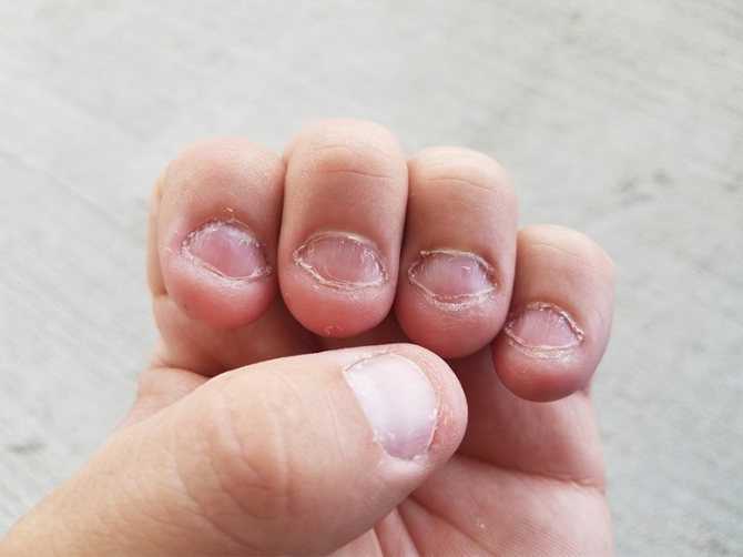 Ребёнок грызёт ногти - почему и что делать: причины и советы детского психолога | rucheyok.ru