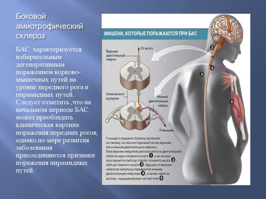 Боковой амиотрофический склероз — википедия с видео // wiki 2